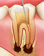 虫歯・精密根管治療