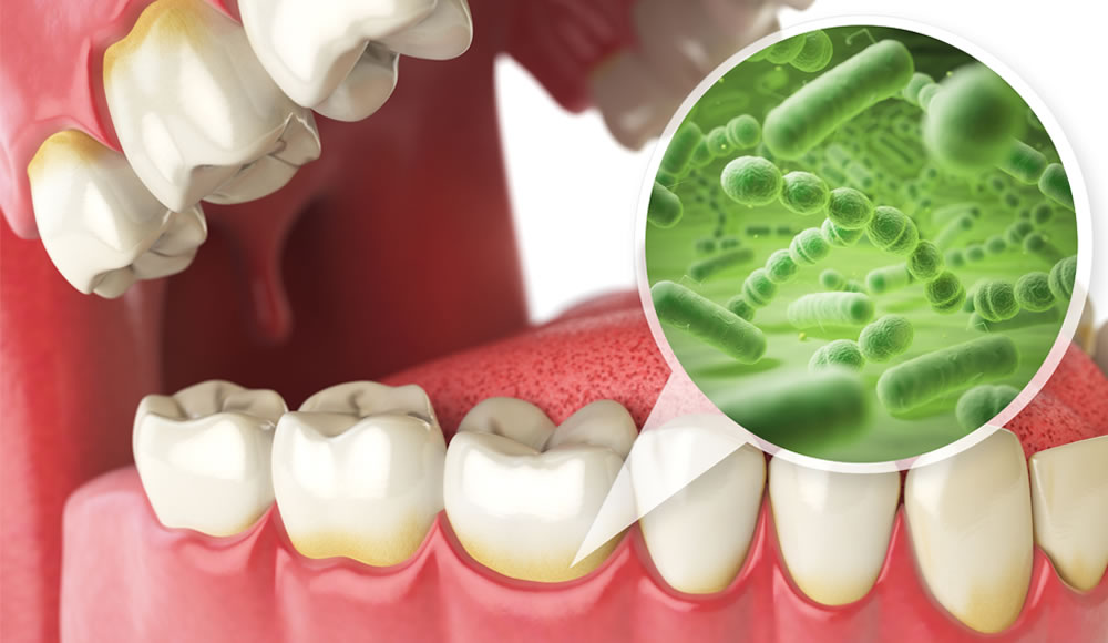 歯周病が悪化・進行する要因とは？