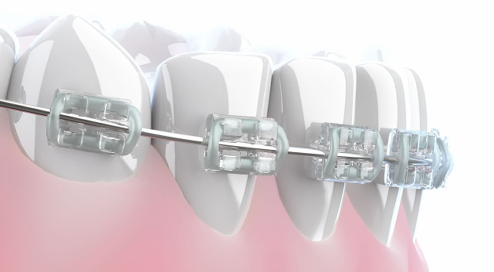 矯正治療中の虫歯リスクを軽減