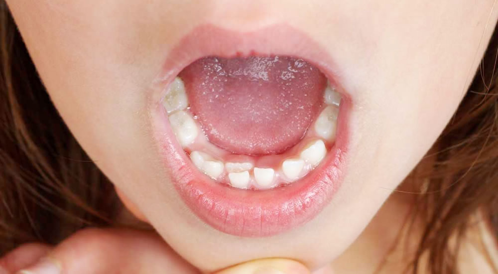 生まれつき歯の数が多い過剰歯とは？