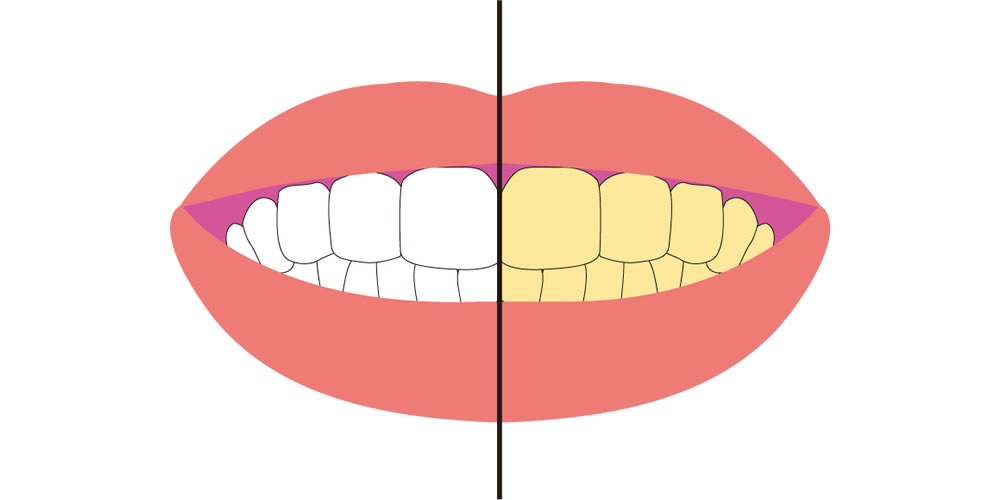 加齢に伴って歯が黄ばむ原因