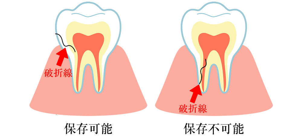 保存できる歯と保存不可能な歯