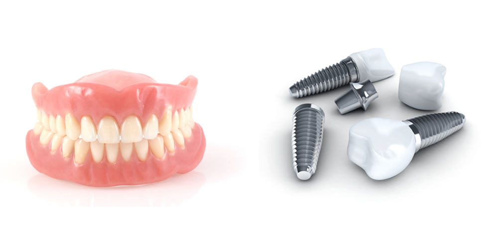 入れ歯とインプラントのメリット・デメリット