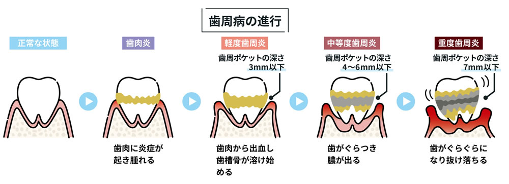 歯周病を放置することで生じる問題
