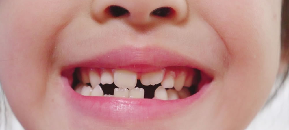 生え変わる乳歯の抜き方と注意点