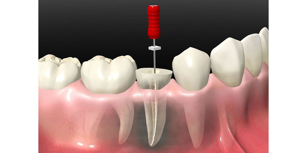 歯の神経を抜いた後に起こる変化とは？