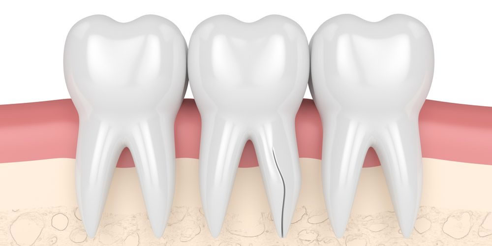 抜歯する可能性の高い歯根破折の症状と原因とは？