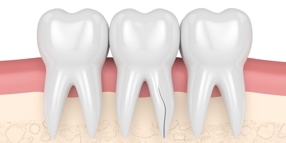 歯根破折