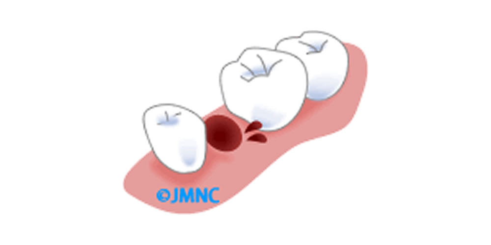 歯を抜いた後の出血