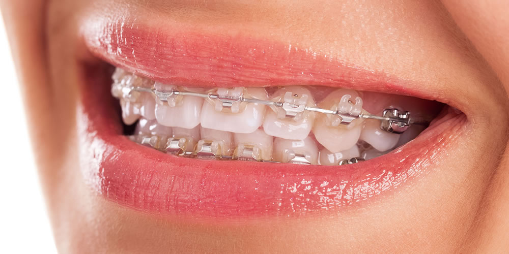 矯正治療で歯をスムーズに動かせる人の特徴とは？