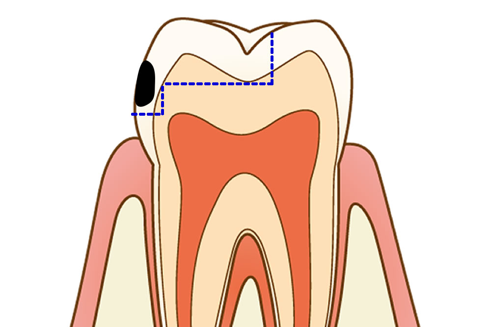 虫歯治療前