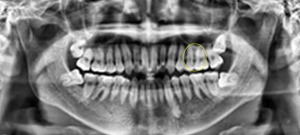 レントゲン検査