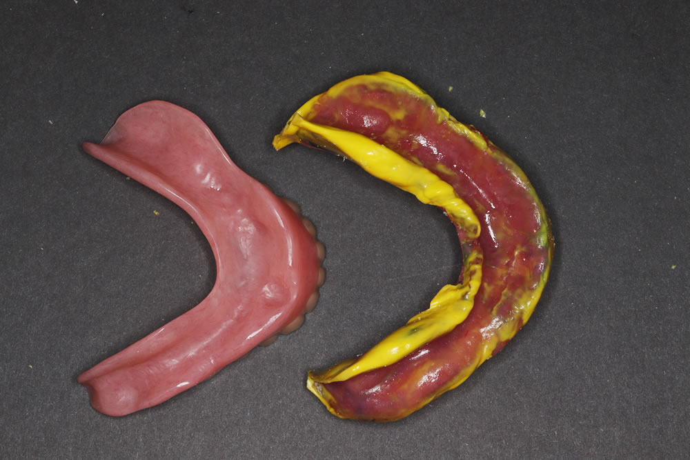 内面の精密印象(シリコーン印象)