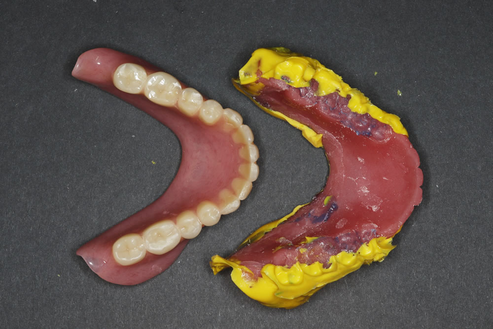 咬合採得(噛み合わせの記録)