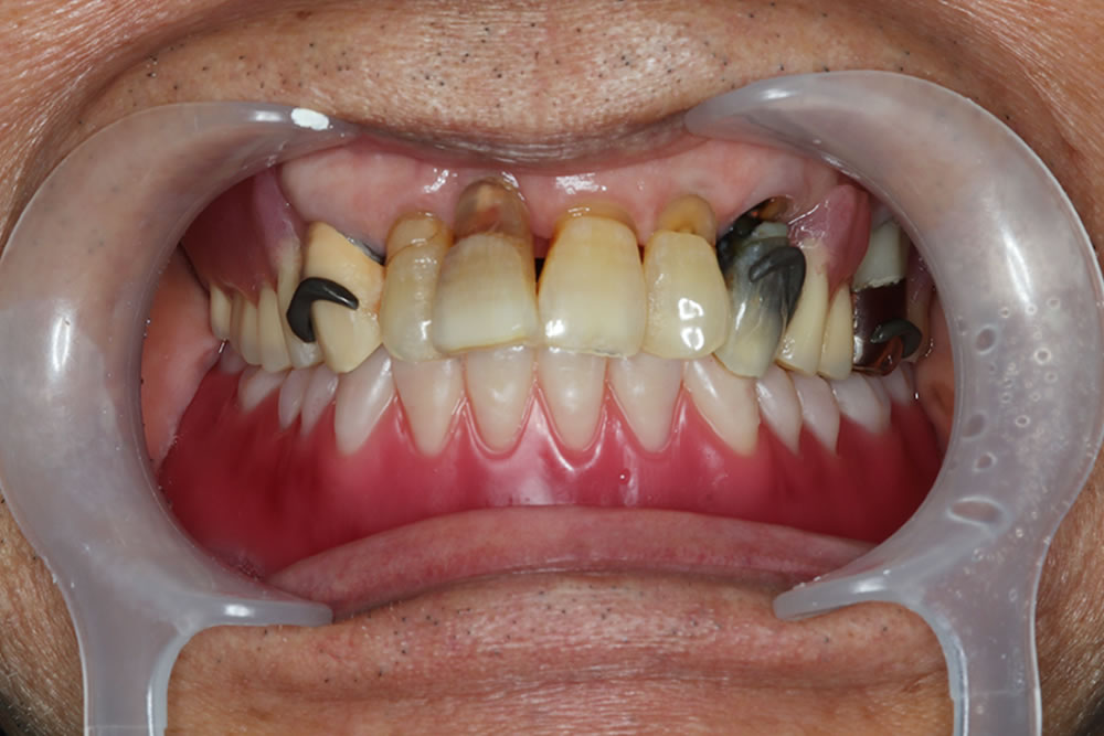 人工歯の配列・試適