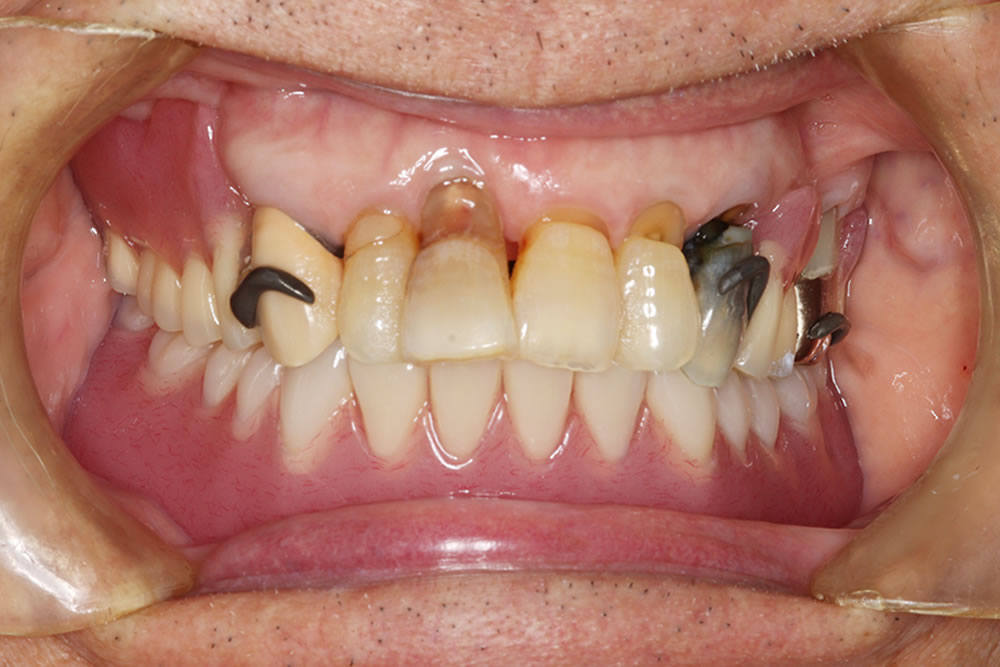 最終義歯の完成(Set)