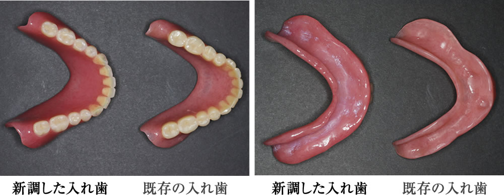既存の入れ歯と新調した入れ歯の比較