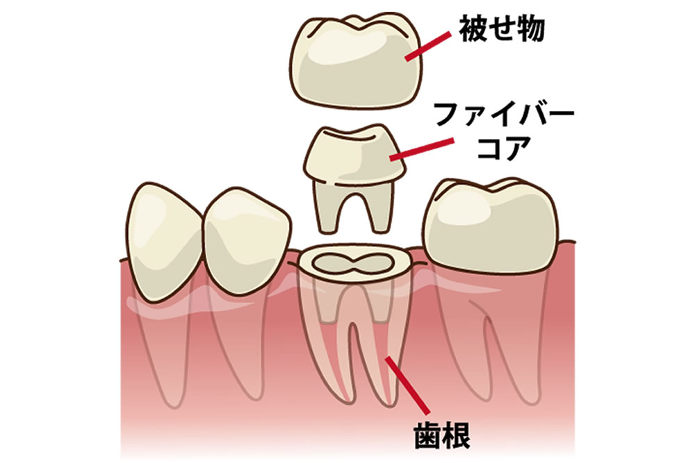 ファイバーコアによる土台の作製