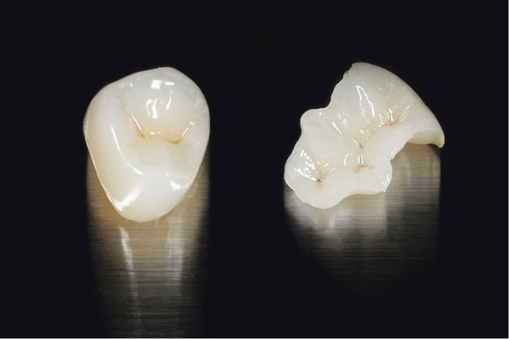 セラミックインレー