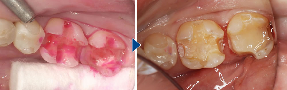 虫歯・劣化部分の確認と形成(形を整える)