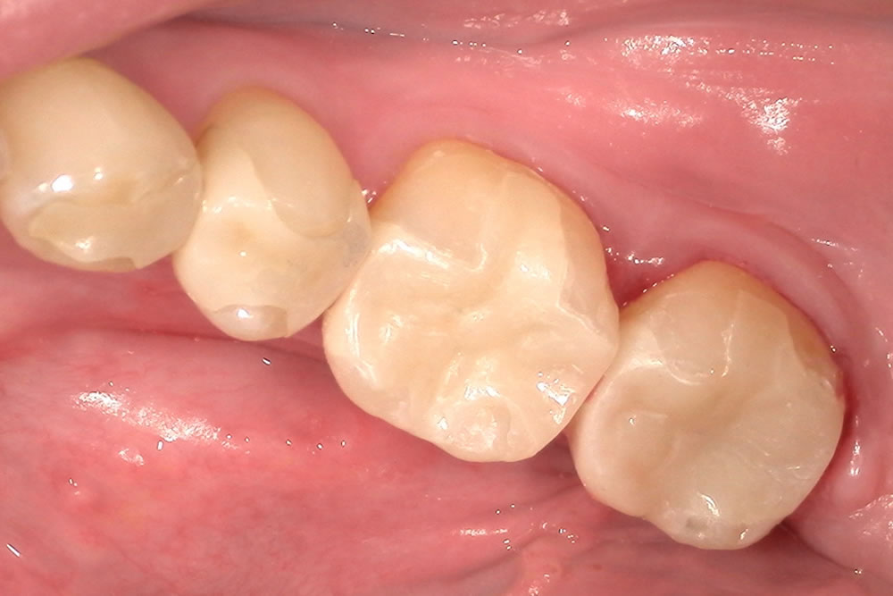 接着(装着)と噛み合わせの調整・治療完了