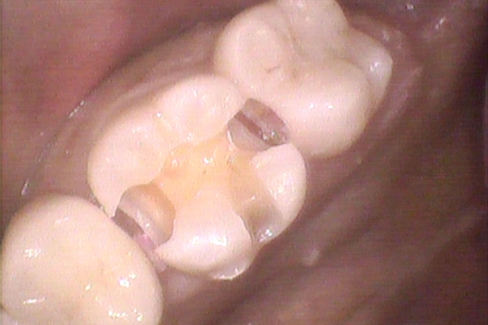 虫歯治療の実施