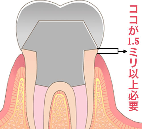 フェルール効果