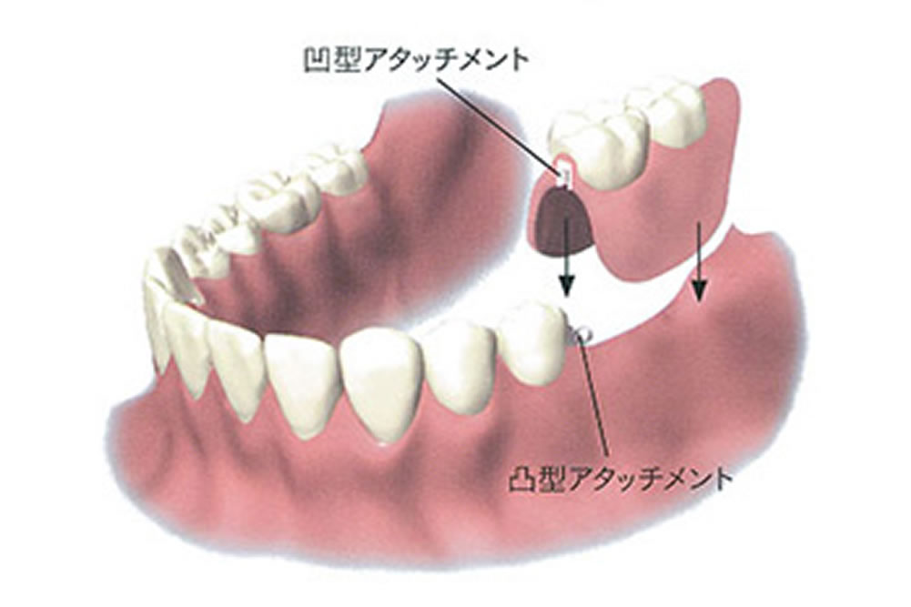 アタッチメントデンチャー