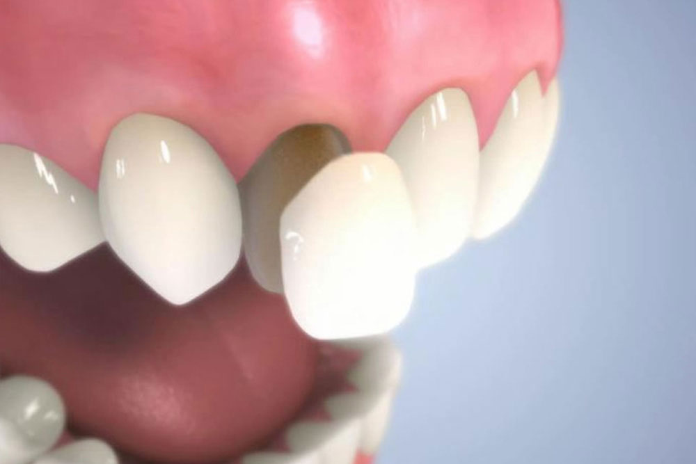 前歯特化型の審美修復法ラミネートベニア