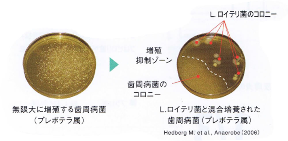 「細菌療法」バクテリアセラピー
