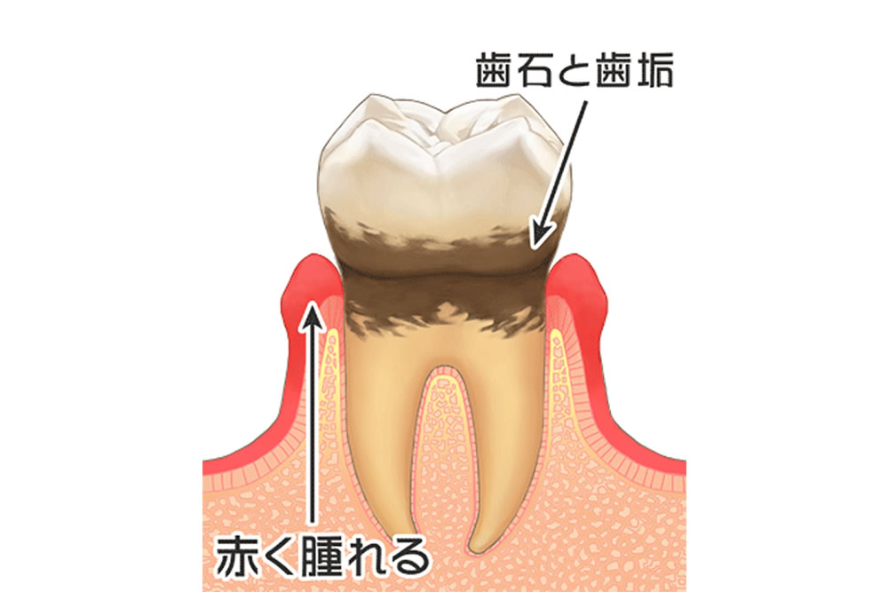歯肉炎（軽度の歯周病）