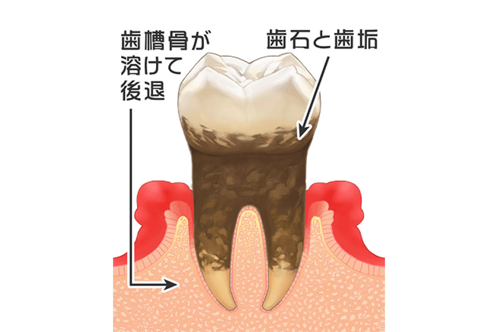 歯周炎（中度～重度の歯周病）